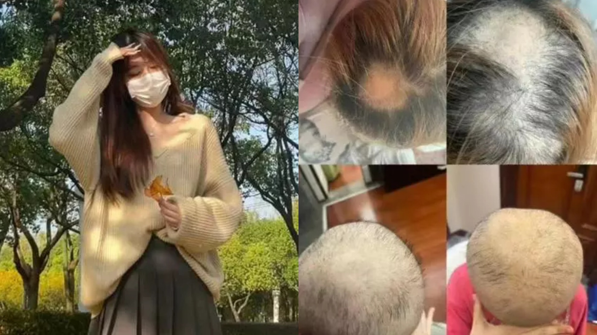 19歲女染髮後7天現嚴重脫髮恐永久光頭！醫生：6類人不建議染髮