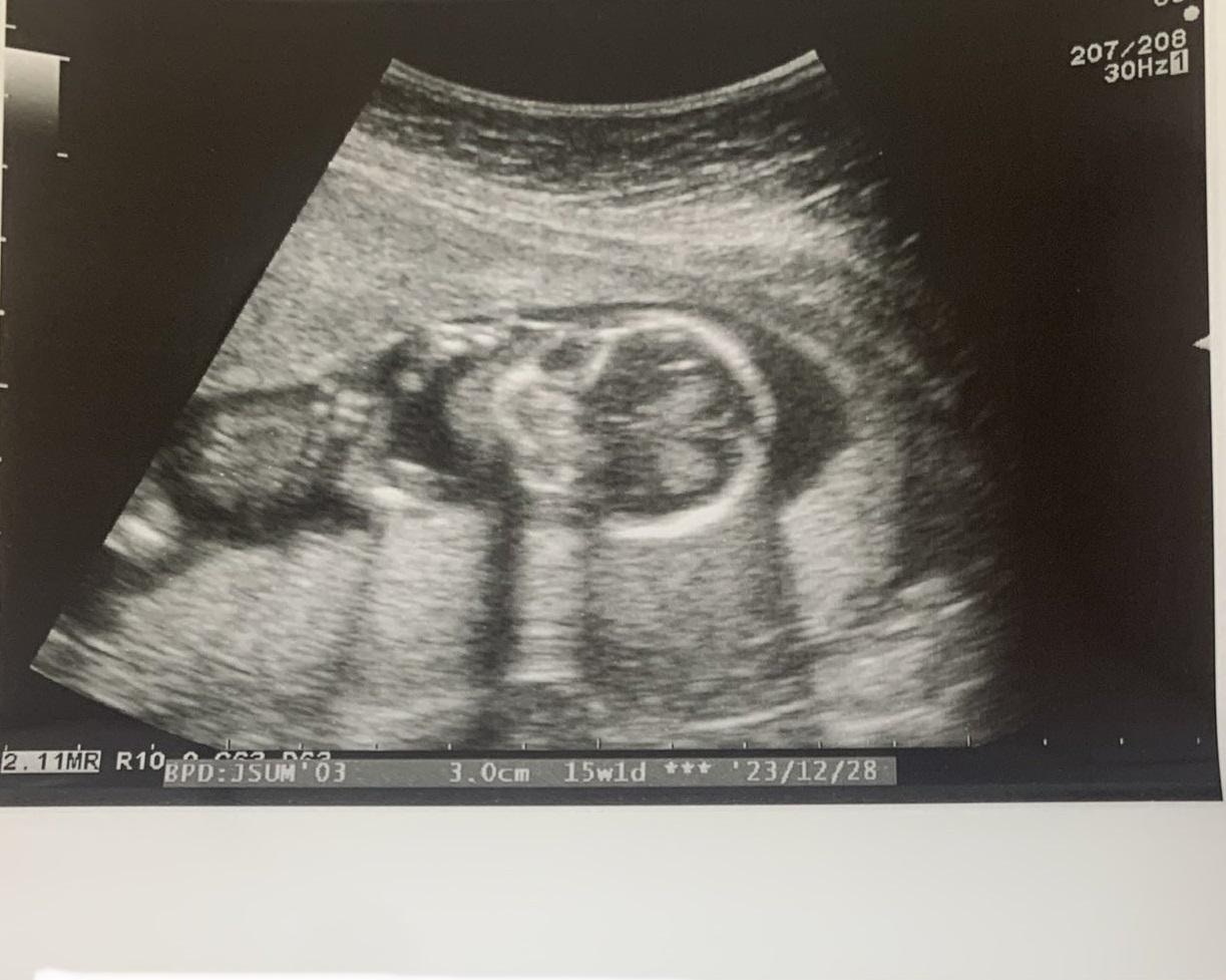 今井賢在自己的Twitter公開了其中兩張超音波影像，收到了意想不到的大量留言！例如這一樣…（X / 今井賢 Ken Imai@zoom婦人科医@kunkun421）