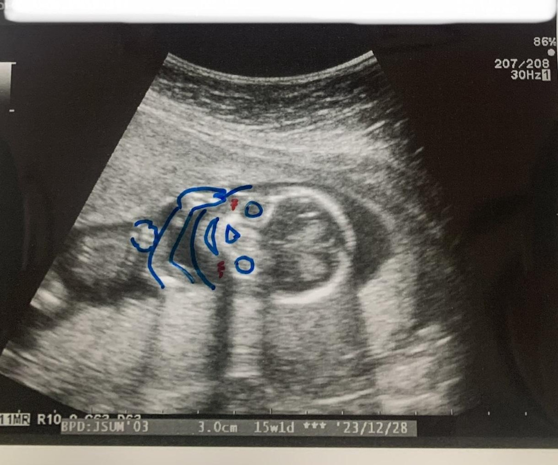 用筆加添了五官,準爸媽就大概可知肚內孩子的模樣了!(X / 今井賢 Ken Imai@zoom婦人科医@kunkun421) 用筆加添了五官,準爸媽就大概可知肚內孩子的模樣了!(X / 今井賢 Ken Imai@zoom婦人科医@kunkun421)