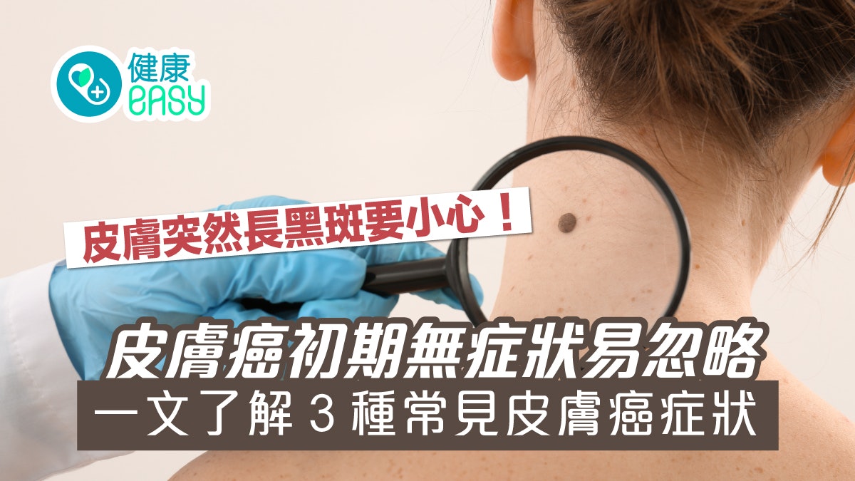 皮膚癌|黑斑邊緣不規則凹凸不平要小心!細數3種常見皮膚癌症狀 皮膚癌|黑斑邊緣不規則凹凸不平要小心!細數3種常見皮膚癌症狀
