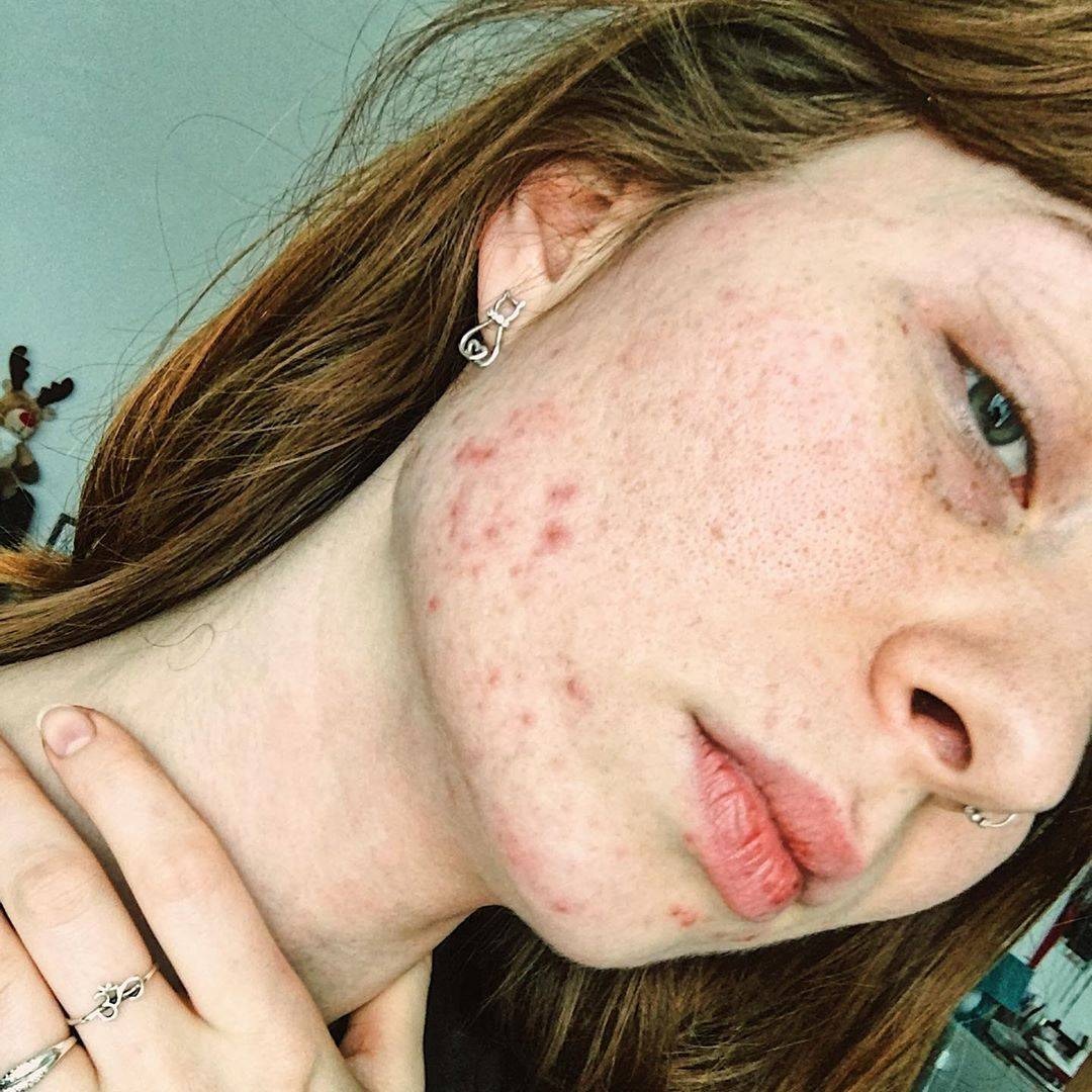 Ivana Kostova自11歲深受暗瘡困擾（IG@ikbeautyofficial）