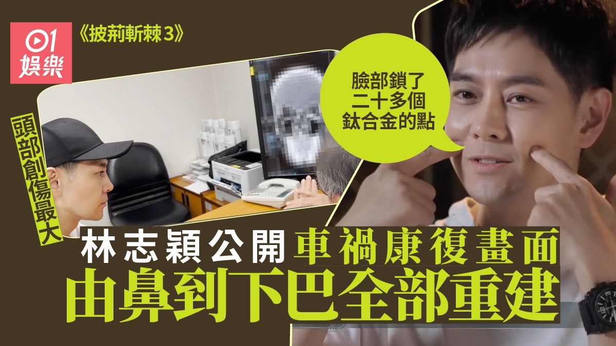 林志穎慶幸車禍兒子無受傷 手部仍有11條鈦合金釘:現在無法伸直 林志穎慶幸車禍兒子無受傷 手部仍有11條鈦合金釘:現在無法伸直