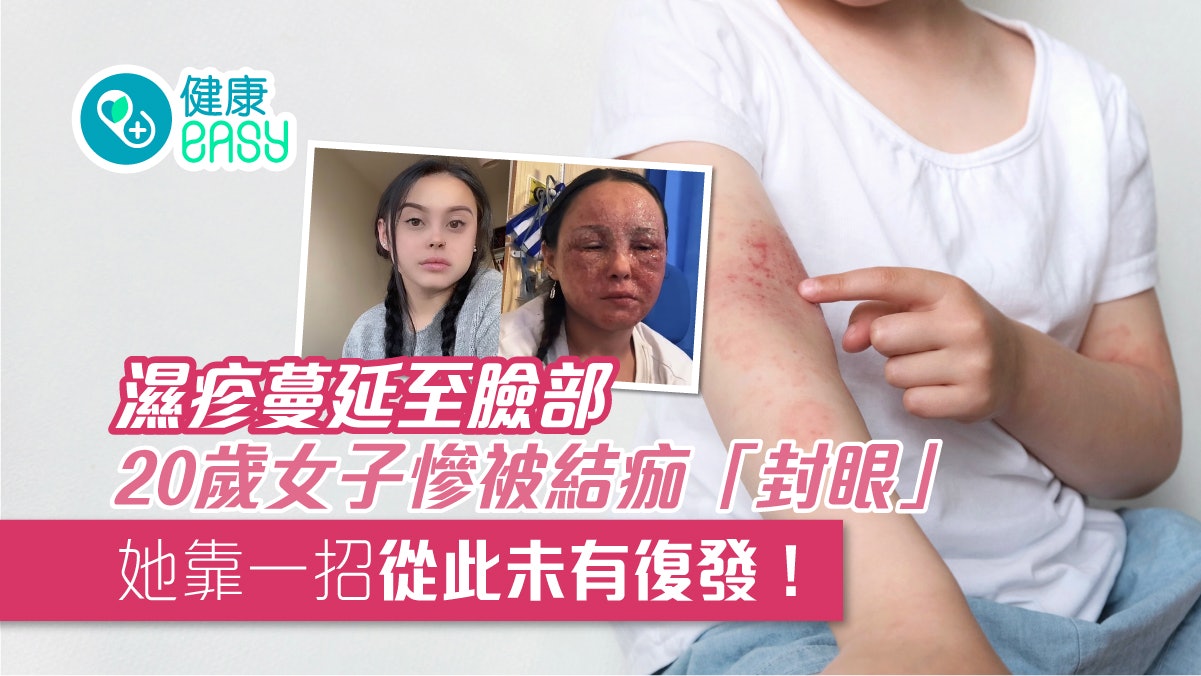 濕疹|20歲女子濕疹嚴重發作 臉部皮膚不斷剝落 慘被結痂「封眼」 濕疹|20歲女子濕疹嚴重發作 臉部皮膚不斷剝落 慘被結痂「封眼」