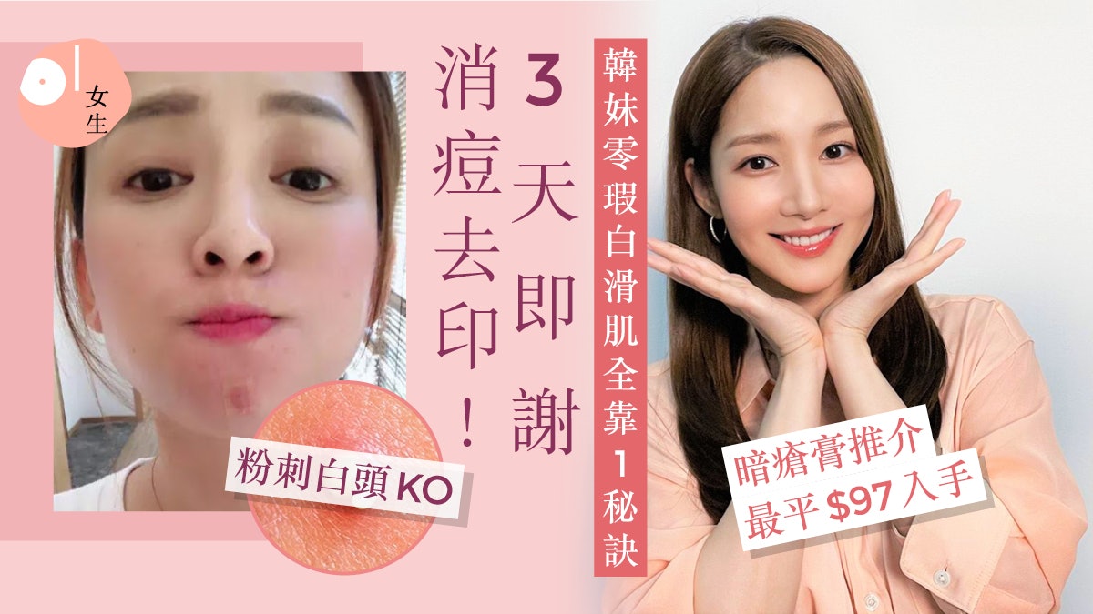 暗瘡|韓妹推「3天痘痘急救法」消痘去印告別爛臉!附暗瘡膏推介 暗瘡|韓妹推「3天痘痘急救法」消痘去印告別爛臉!附暗瘡膏推介