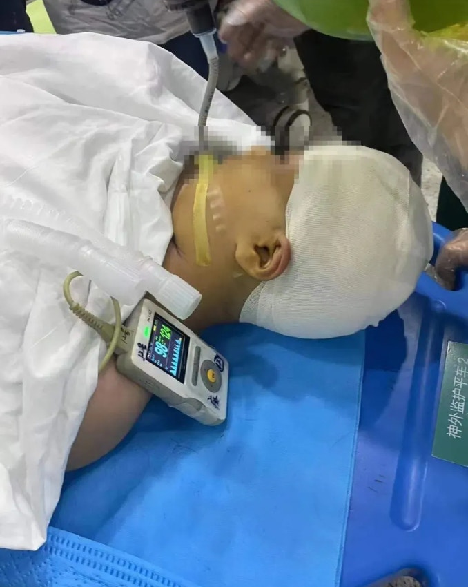 長沙一名小學生近日遭到老師用三角尺毆打致頭部受傷住院，一度有生命危險。（大皖新聞）