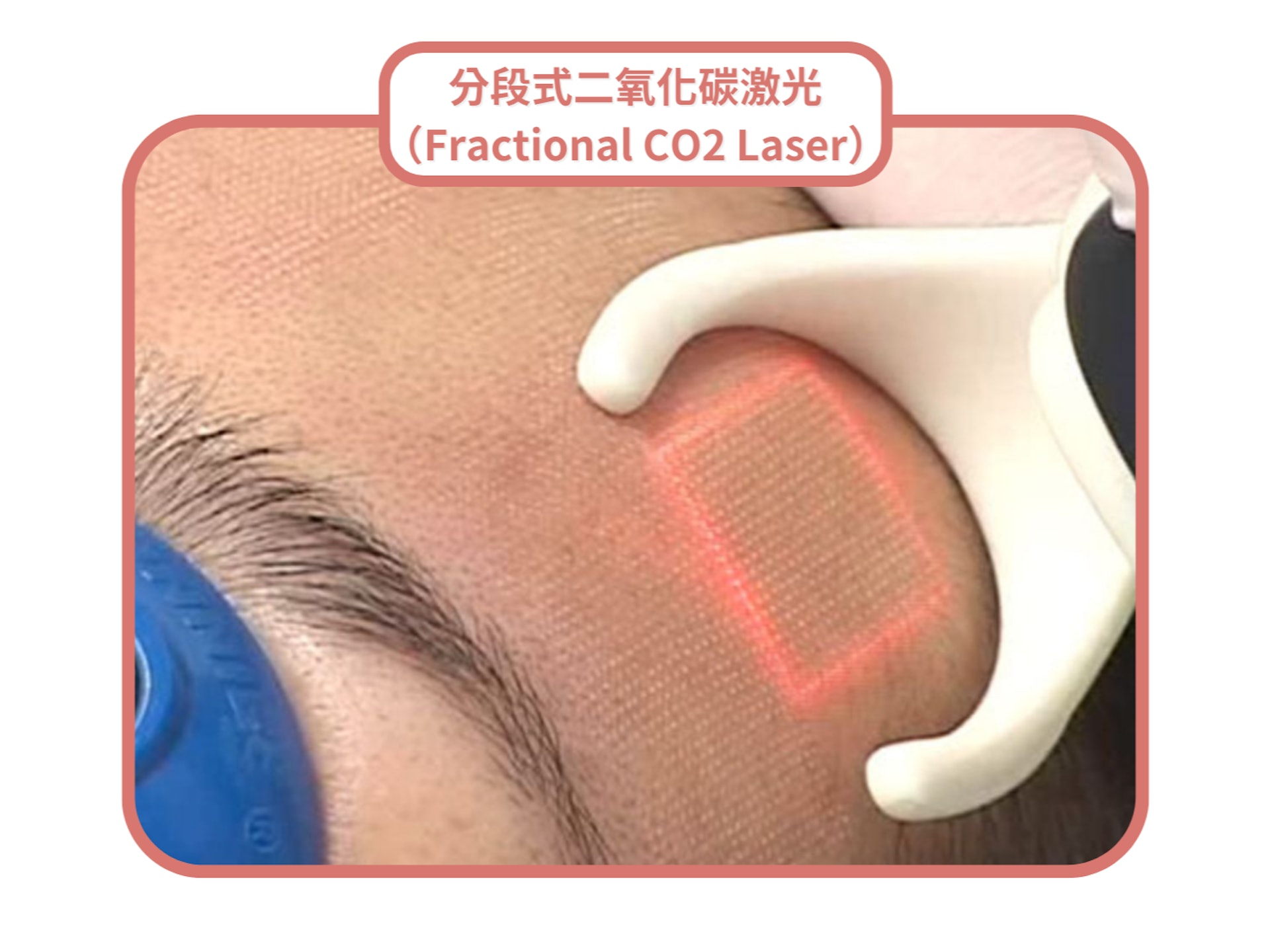 分段式二氧化碳激光（Fractional CO2 Laser）會以點陣式輸出能量於皮膚上，形成規律排列的微小細孔。（圖片：Shutterstock）