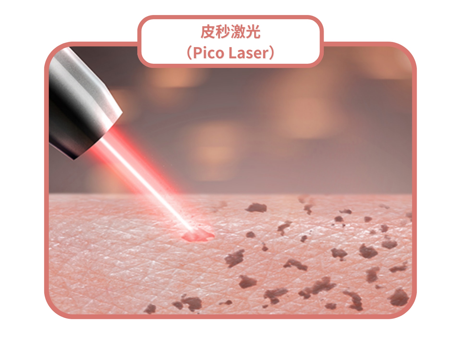 皮秒激光（Pico Laser）可擊碎皮膚層的黑色素，達至美白淡斑效果。（圖片：Shutterstock）