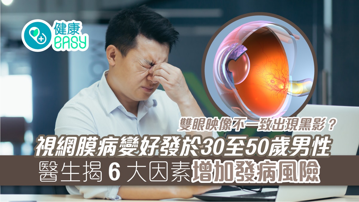 視網膜病變|眼前有黑影?好發於30至50歲男性 6因素增發病風險 視網膜病變|眼前有黑影?好發於30至50歲男性 6因素增發病風險