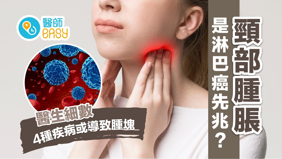 頭頸部癌 從頸淋巴追蹤癌症源頭– 癌症資訊網