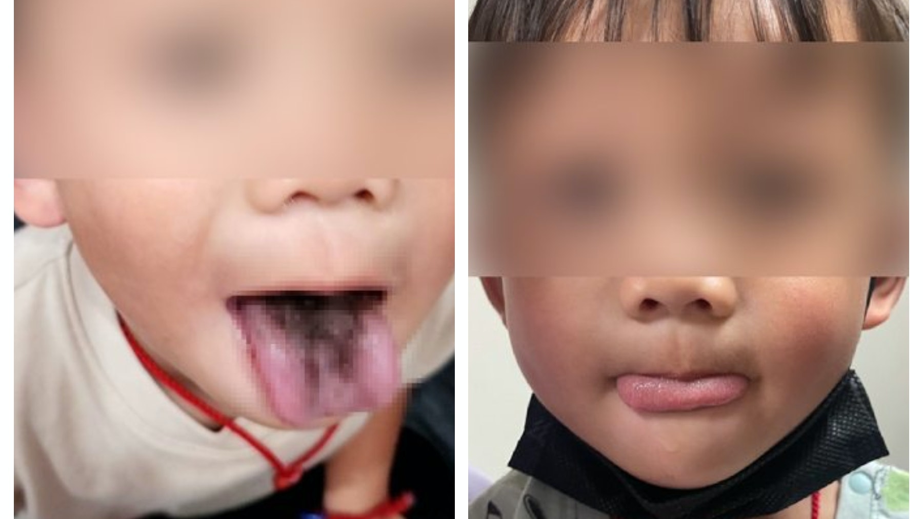 4歲男童舌頭長「黑毛」!不痛無異味 或與長期使用抗生素有關 4歲男童舌頭長「黑毛」!不痛無異味 或與長期使用抗生素有關