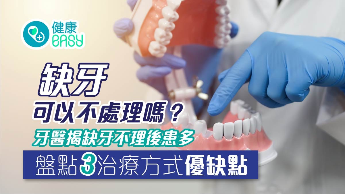 牙齒健康|缺牙可以不處理嗎?盤點3治療方式優缺點維護口腔健康 牙齒健康|缺牙可以不處理嗎?盤點3治療方式優缺點維護口腔健康