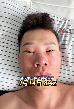 北京一名長相斯文的男子，因長期挖鼻孔導致鼻腔黏膜受損，而感染丹毒，其面部亦受此影響腫脹成「豬頭」模樣。（影片截圖）