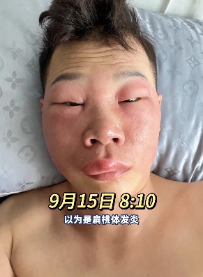北京一名長相斯文的男子，因長期挖鼻孔導致鼻腔黏膜受損，而感染丹毒，其面部亦受此影響腫脹成「豬頭」模樣。（影片截圖）
