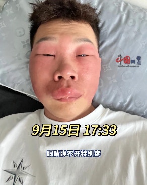 北京一名長相斯文的男子，因長期挖鼻孔導致鼻腔黏膜受損，而感染丹毒，其面部亦受此影響腫脹成「豬頭」模樣。（影片截圖）