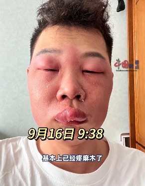北京一名長相斯文的男子，因長期挖鼻孔導致鼻腔黏膜受損，而感染丹毒，其面部亦受此影響腫脹成「豬頭」模樣。（影片截圖）