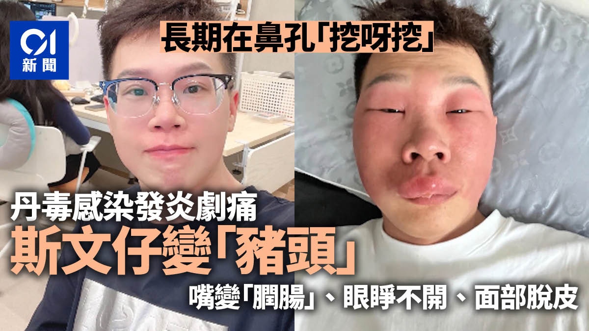 狂在鼻孔裏「挖呀挖」　北京斯文男感染丹毒　面部腫成「豬」模樣