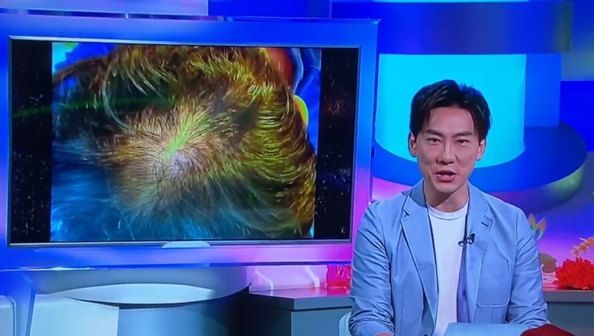 【植髮】胡亂植人工頭髮 或會造成嚴重副作用! 【植髮】胡亂植人工頭髮 或會造成嚴重副作用!