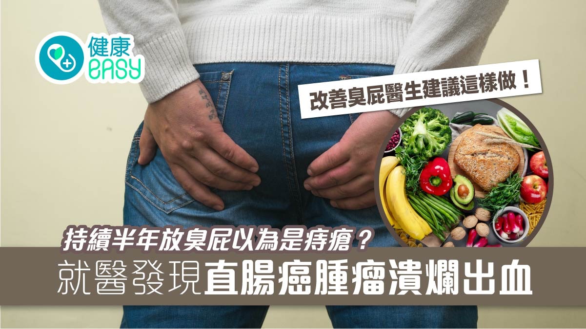 大腸癌|男子持續半年放臭屁 就醫揭直腸潰爛出血 改善建議這樣做 大腸癌|男子持續半年放臭屁 就醫揭直腸潰爛出血 改善建議這樣做