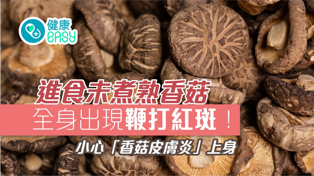 食物安全|全身現鞭打狀紅斑與生食香菇有關?專家教你避免方法 食物安全|全身現鞭打狀紅斑與生食香菇有關?專家教你避免方法