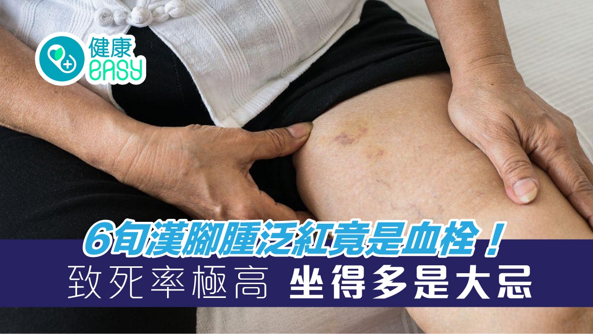 銀髮心臟｜6旬漢腳腫泛紅竟是血栓！致死率極高　坐得多是大忌