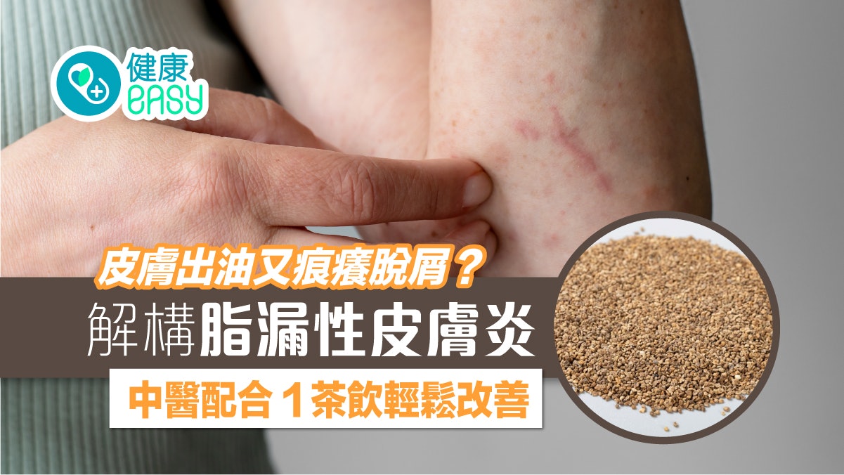 皮膚炎|皮膚出油又痕癢脫屑?中醫分析脂漏性皮膚炎用1茶飲改善 皮膚炎|皮膚出油又痕癢脫屑?中醫分析脂漏性皮膚炎用1茶飲改善