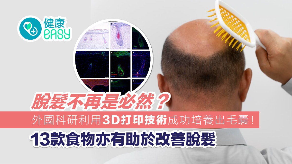 脫髮|外國科研利用3D打印培養出毛嚢 這些亦食物有助改善脫髮! 脫髮|外國科研利用3D打印培養出毛嚢 這些亦食物有助改善脫髮!