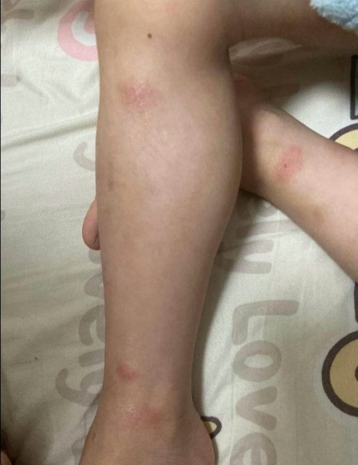 有港媽於facebook群組發文求助，指孩子常於大角咀1個遊樂場玩耍，但多次遭到惡蚊叮咬，雙腿留下明顯發紅蚊癩，因而希望向當局投訴要求改善。（fb「我長於大角咀重生版」圖片）