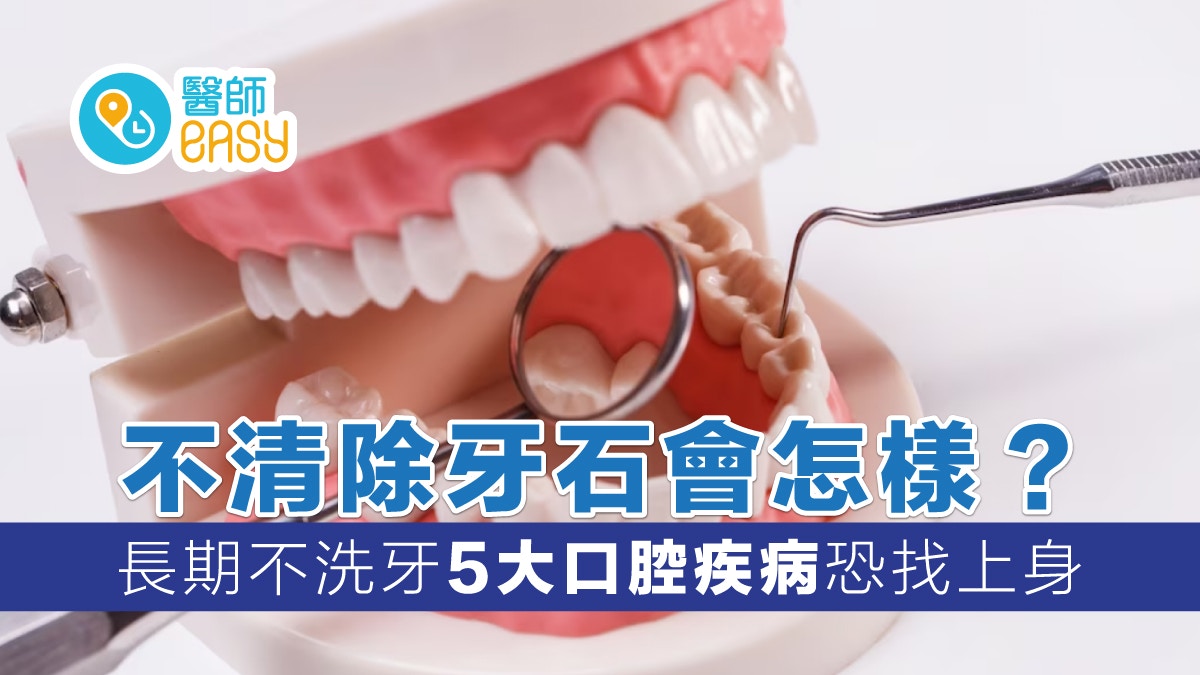 牙齒健康｜不清除牙石會怎樣？長期不洗牙5大口腔疾病恐找上身