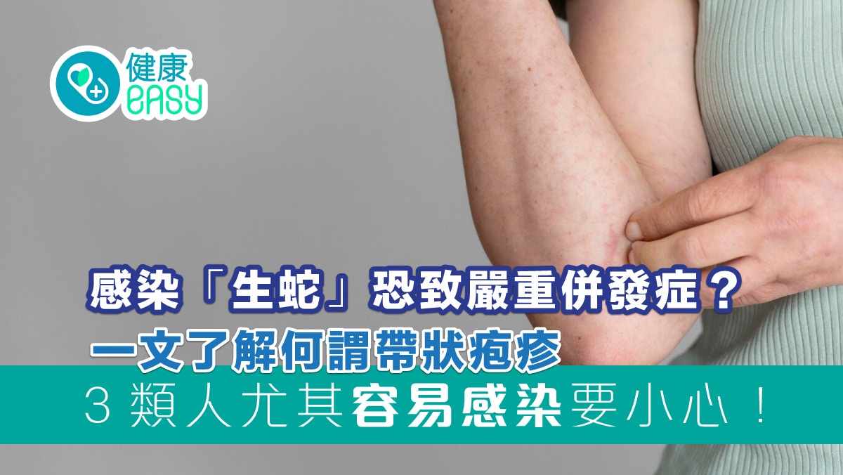 帶狀疱疹｜早期紅斑幾天後長水泡持續刺痛！這些人容易生蛇要小心