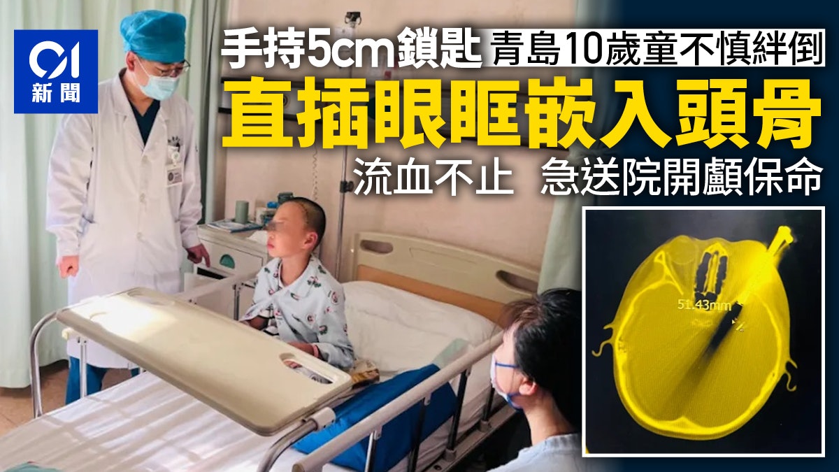 青島10歲男童絆倒摔跤 5cm鎖匙直插眼眶嵌入頭骨 送院開顱保命 青島10歲男童絆倒摔跤 5cm鎖匙直插眼眶嵌入頭骨 送院開顱保命