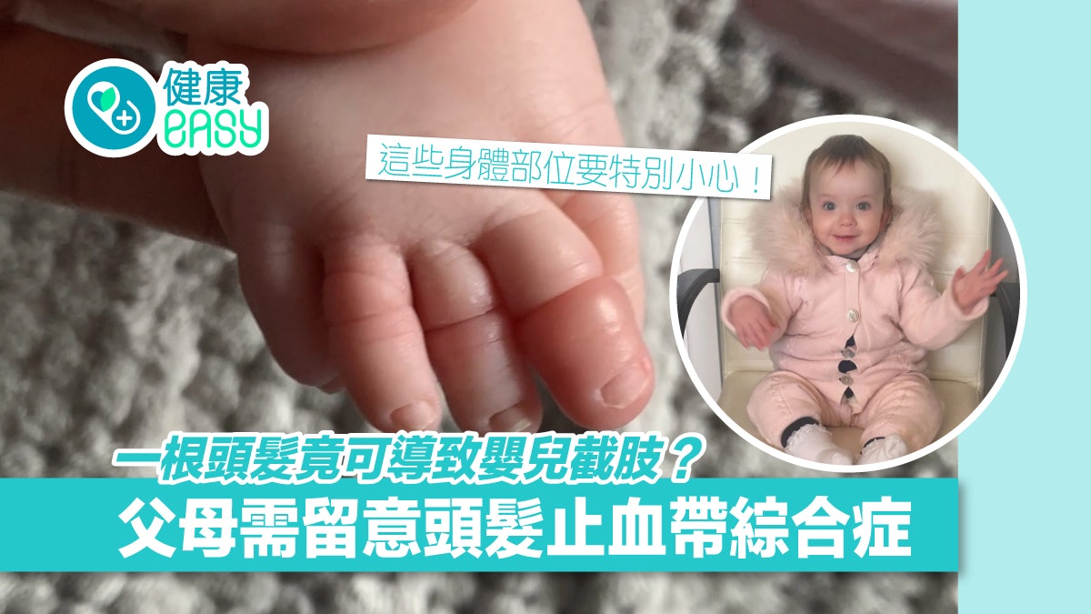 嬰兒疾病|一根頭髮即可令寶寶截肢 這些身體部位需加緊留意! 嬰兒疾病|一根頭髮即可令寶寶截肢 這些身體部位需加緊留意!