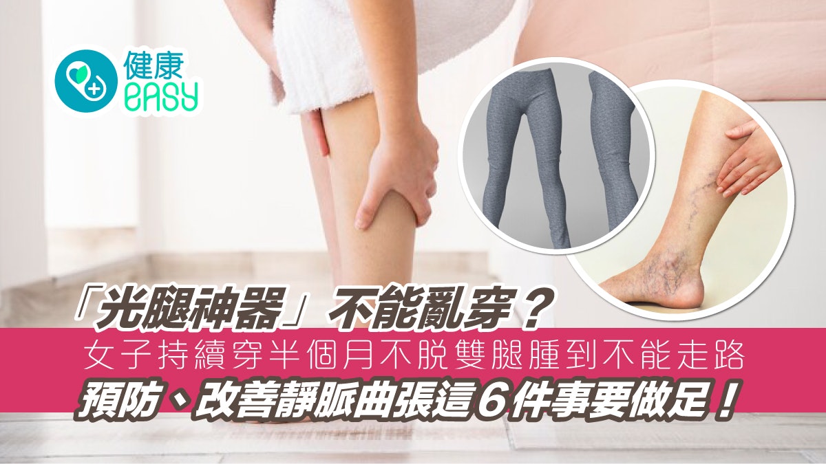 靜脈曲張|內地女穿「光腿神器」不脫 半個月後雙腳腫到不能走路 靜脈曲張|內地女穿「光腿神器」不脫 半個月後雙腳腫到不能走路