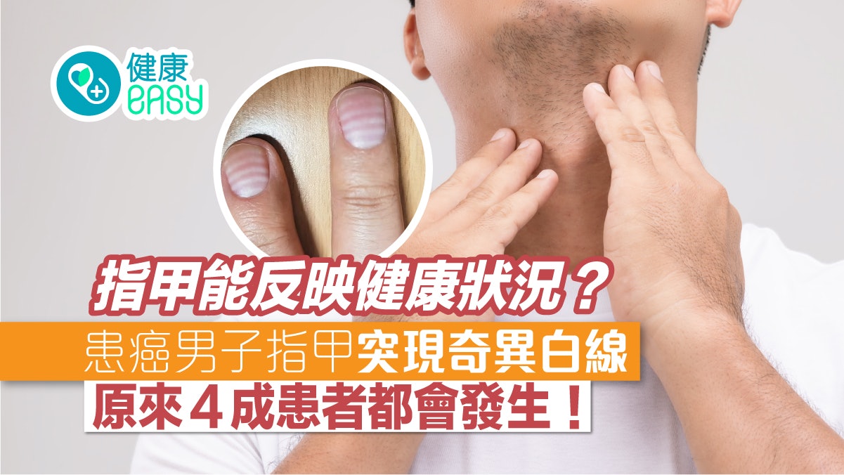 指甲|男子指甲突現奇異白線 醫揭原因:4成患者會發生 指甲|男子指甲突現奇異白線 醫揭原因:4成患者會發生