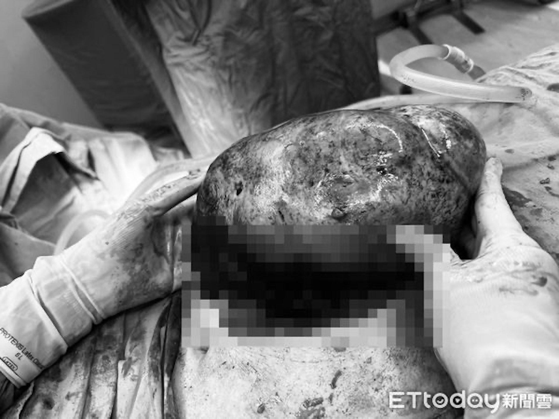 女子肚子裡藏著20厘米的畸胎瘤。(圖片經變色、馬賽克處理/Ettoday及李偉浩醫生授權提供) 女子肚子裡藏著20厘米的畸胎瘤。(圖片經變色、馬賽克處理/Ettoday及李偉浩醫生授權提供)