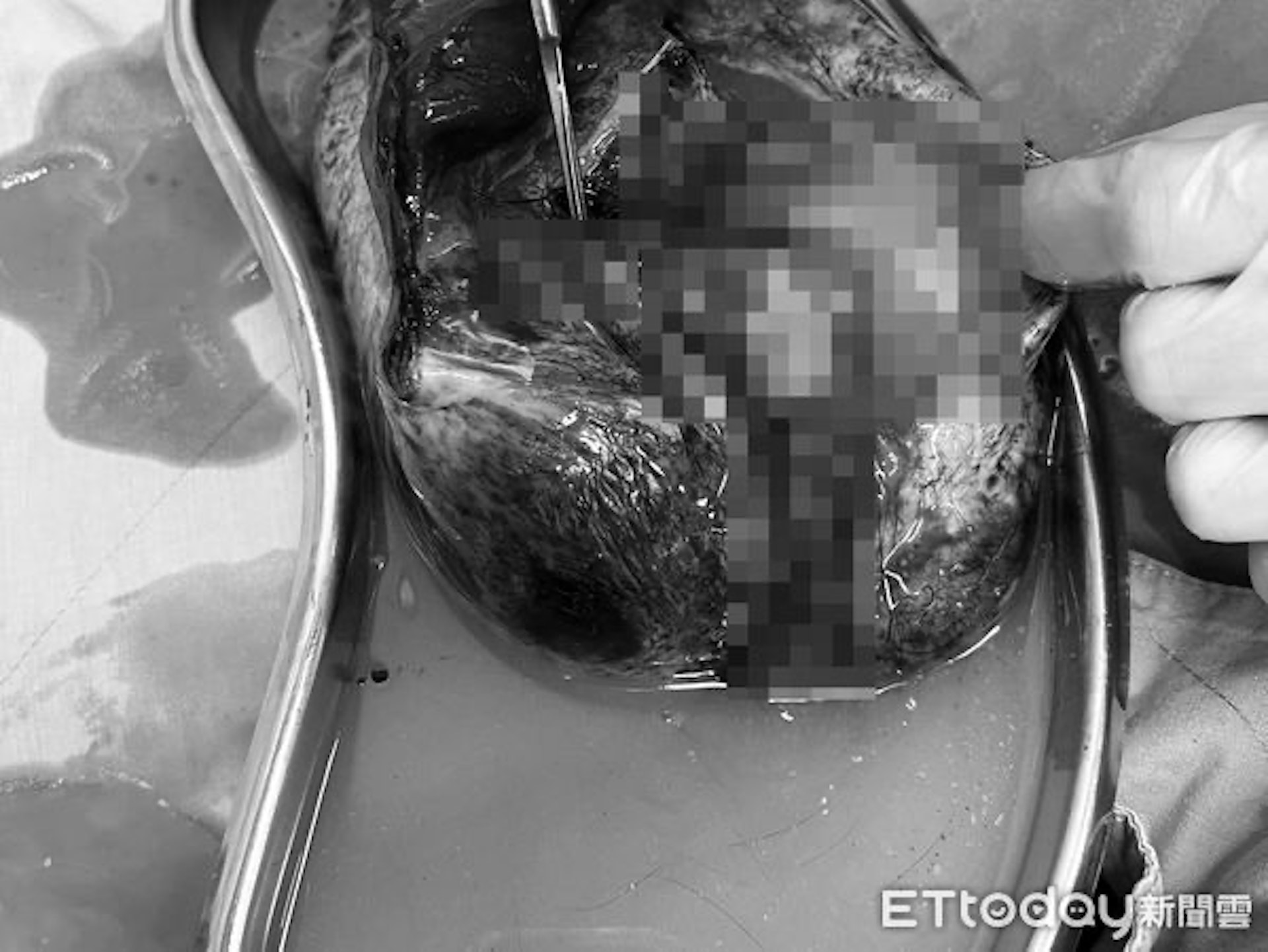 女子肚子裡藏著20厘米的畸胎瘤。（圖片經變色、馬賽克處理／Ettoday及李偉浩醫生授權提供）