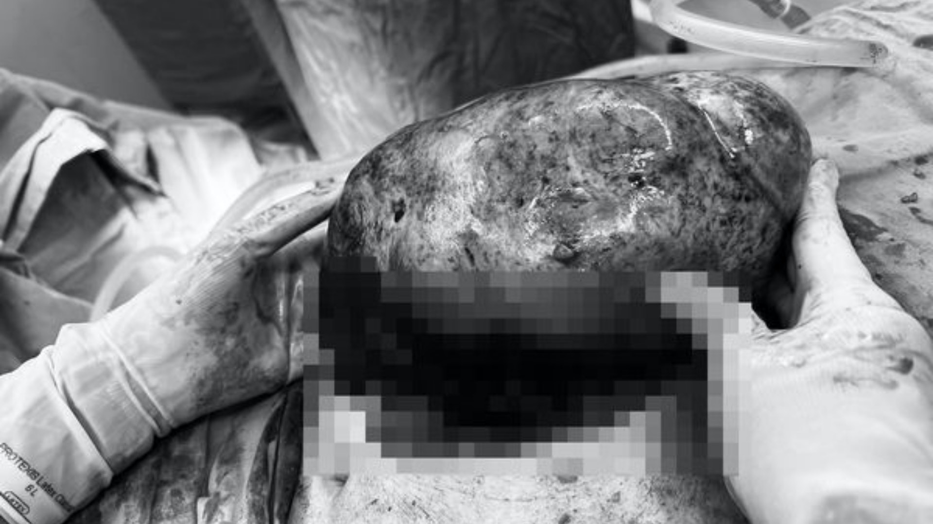 四旬婦肚痛揭卵巢藏20cm畸胎瘤 醫生挖出長髮頭皮軟骨:像貞子! 四旬婦肚痛揭卵巢藏20cm畸胎瘤 醫生挖出長髮頭皮軟骨:像貞子!