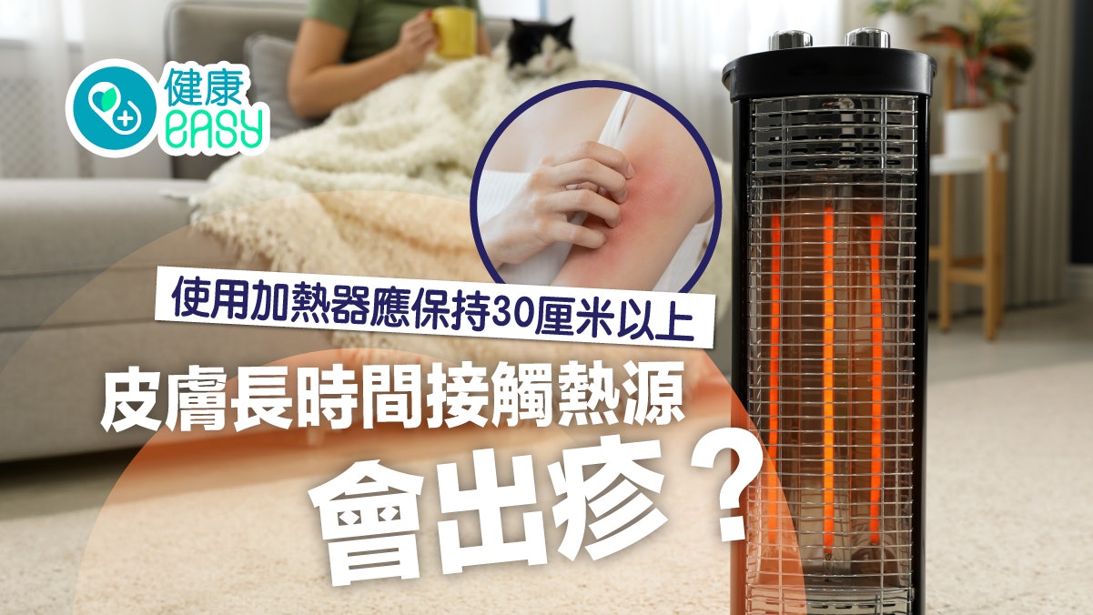 燙傷|皮膚長時間接觸熱源會出疹?使用加熱器應保持30厘米以上 燙傷|皮膚長時間接觸熱源會出疹?使用加熱器應保持30厘米以上