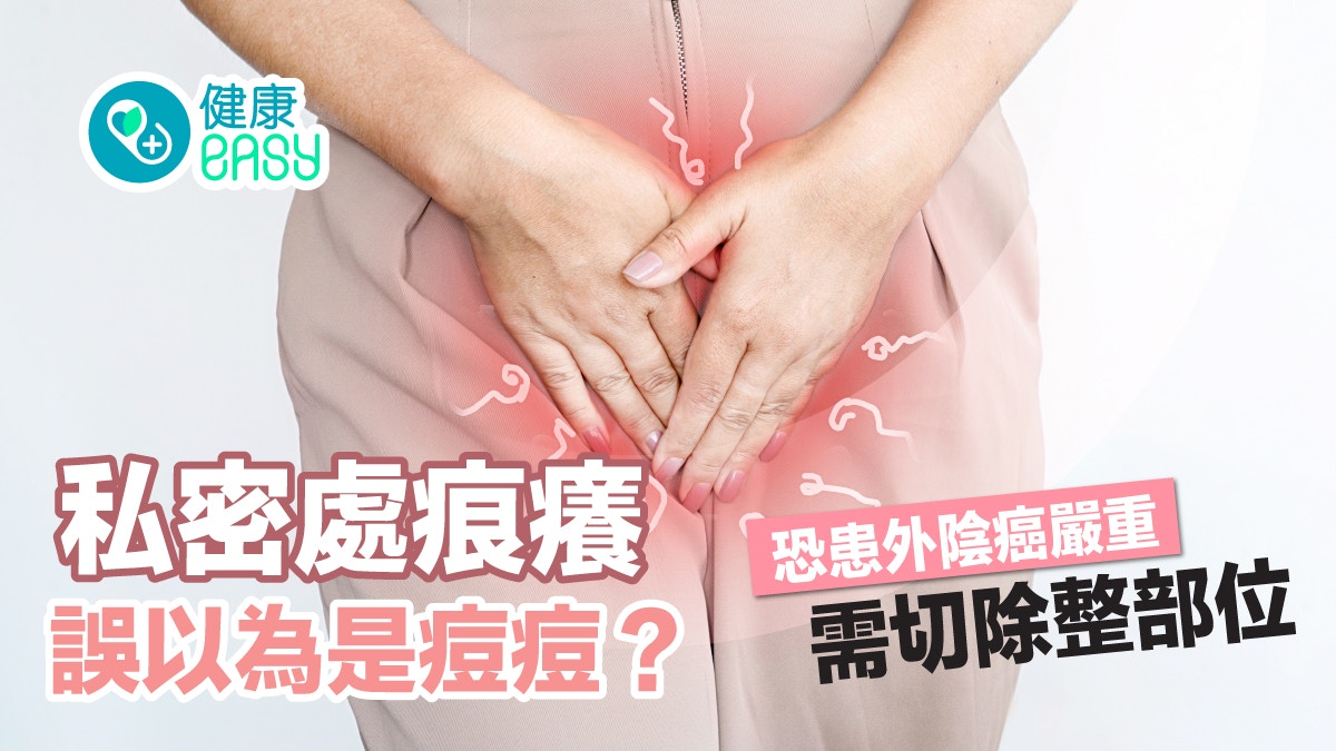 女性健康｜私密處痕癢誤以為是痘痘？恐患外陰癌嚴重需切除整部位