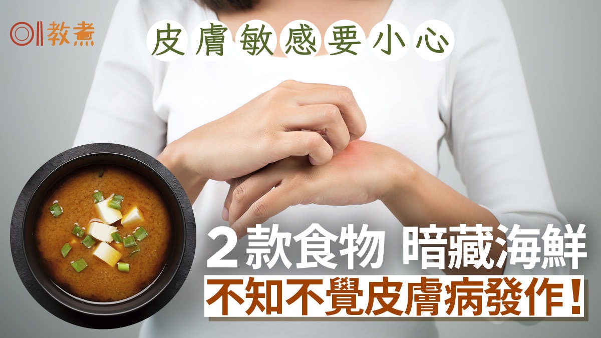 濕疹|冬天常吃2款食物暗藏海鮮隨時皮膚病發作 味噌湯都唔得? 濕疹|冬天常吃2款食物暗藏海鮮隨時皮膚病發作 味噌湯都唔得?