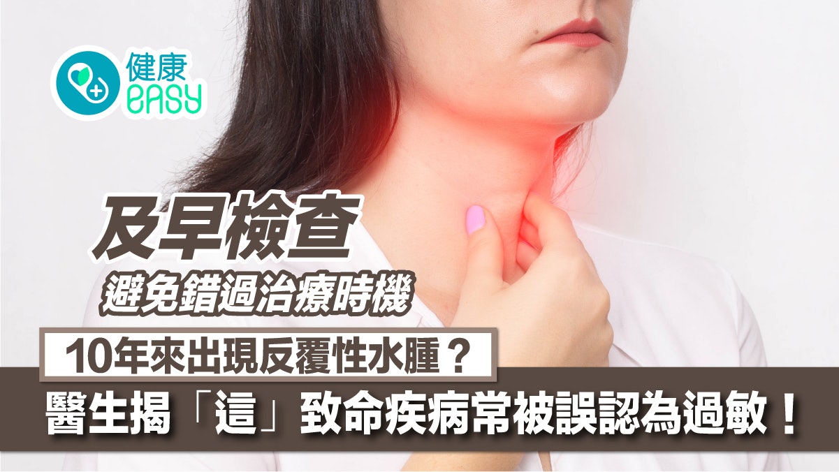 喉嚨腫脹以為只是普通發炎?反覆性水腫可能罹患遺傳性血管性水腫 喉嚨腫脹以為只是普通發炎?反覆性水腫可能罹患遺傳性血管性水腫