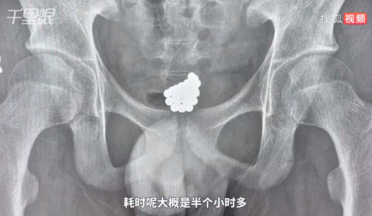深圳14歲男生因為好奇,將30多顆磁珠塞入尿道。(微博影片截圖) 深圳14歲男生因為好奇,將30多顆磁珠塞入尿道。(微博影片截圖)