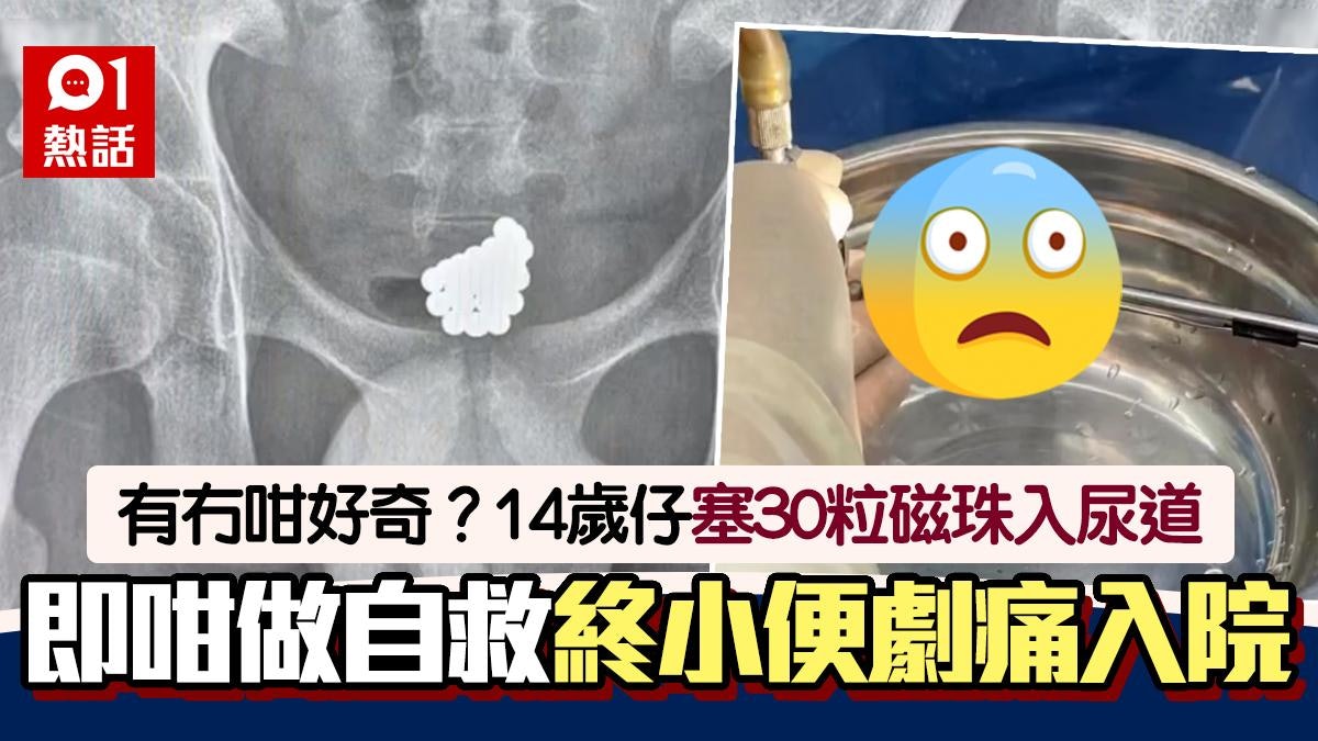 14歲仔30粒磁珠塞下體!尿道塞滿小便極痛竟咁做 4小時後去急症 14歲仔30粒磁珠塞下體!尿道塞滿小便極痛竟咁做 4小時後去急症