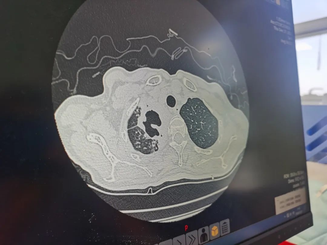 北京胸科醫院，一位肺結核患者的胸部X光片，右肺出現空洞和病灶。（新京報）