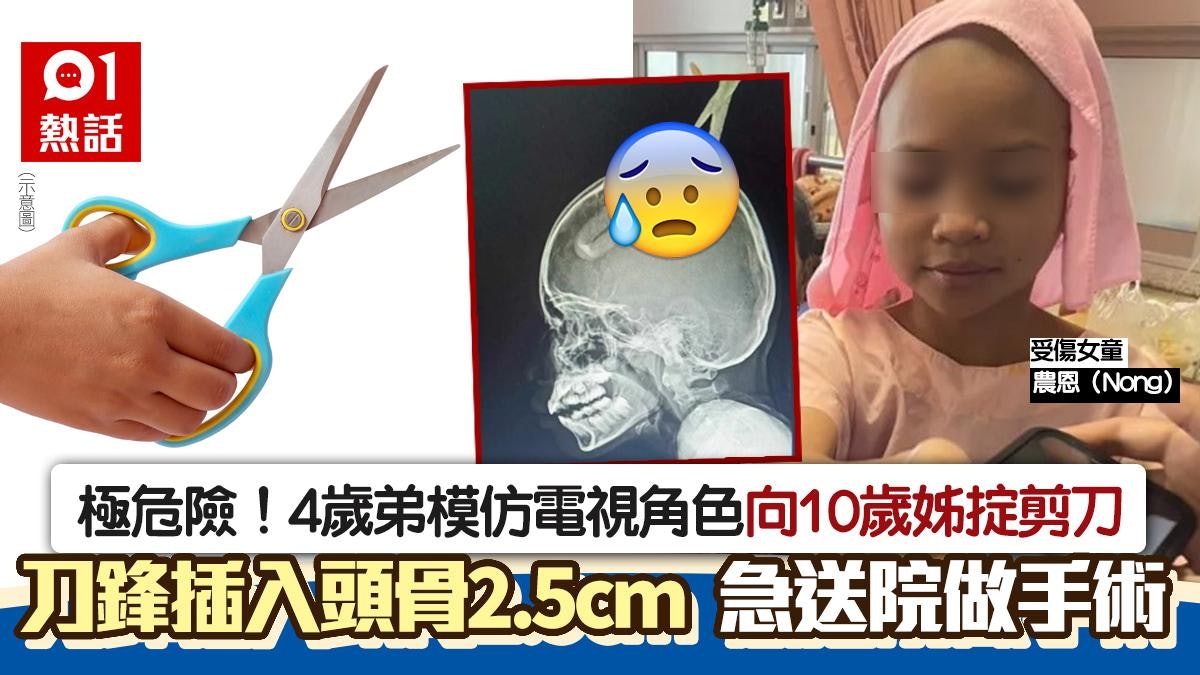 恐怖意外!4歲弟扮電視角色掟剪刀 驚插入10歲姊頭骨深入2.5厘米 恐怖意外!4歲弟扮電視角色掟剪刀 驚插入10歲姊頭骨深入2.5厘米