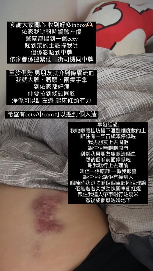 从女事主伤势照片可见，其肩、手、脚等多处有瘀伤。（女事主facebook图片）
