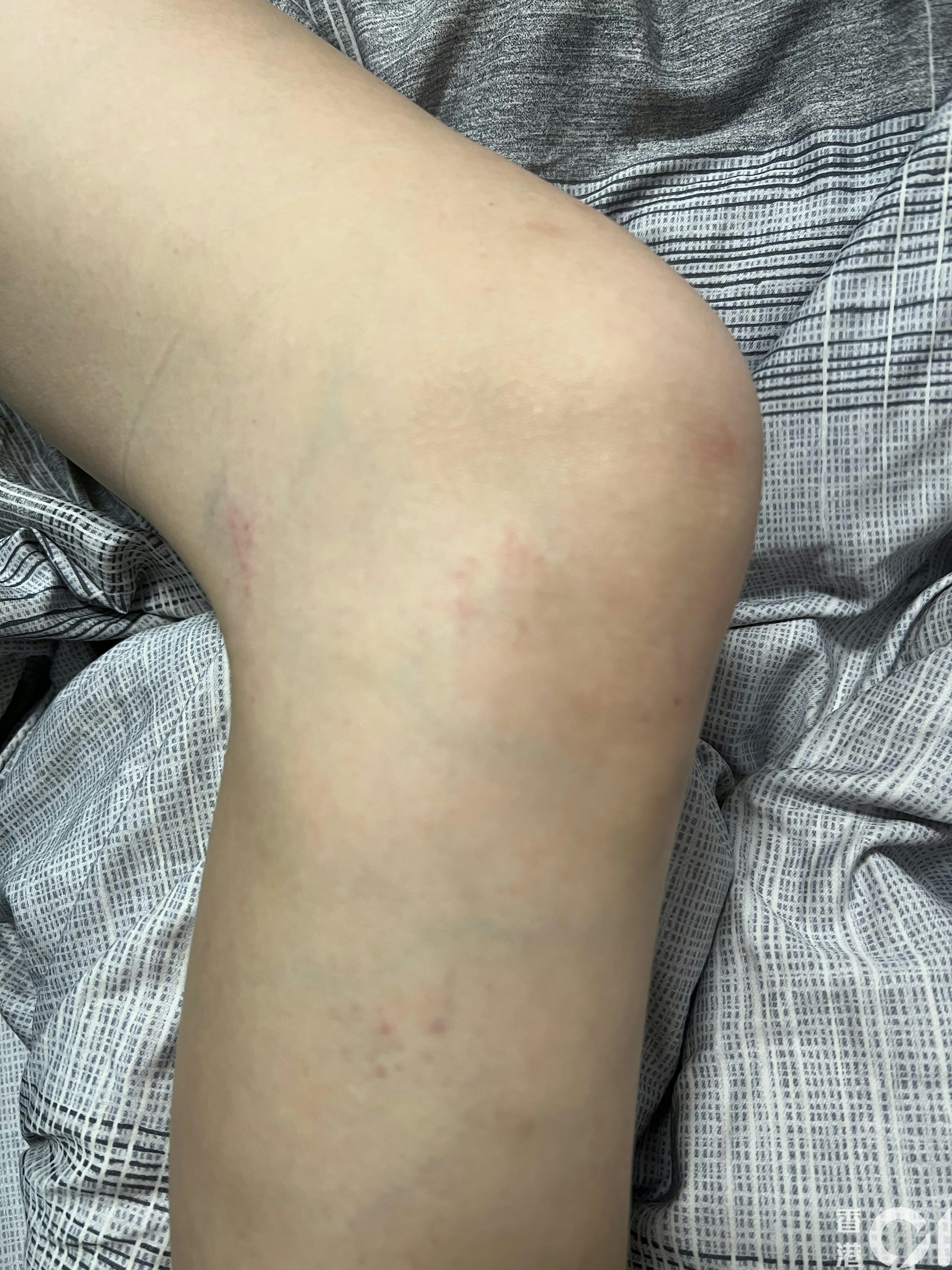 从女事主伤势照片可见，其肩、手、脚等多处有瘀伤。（事主提供）