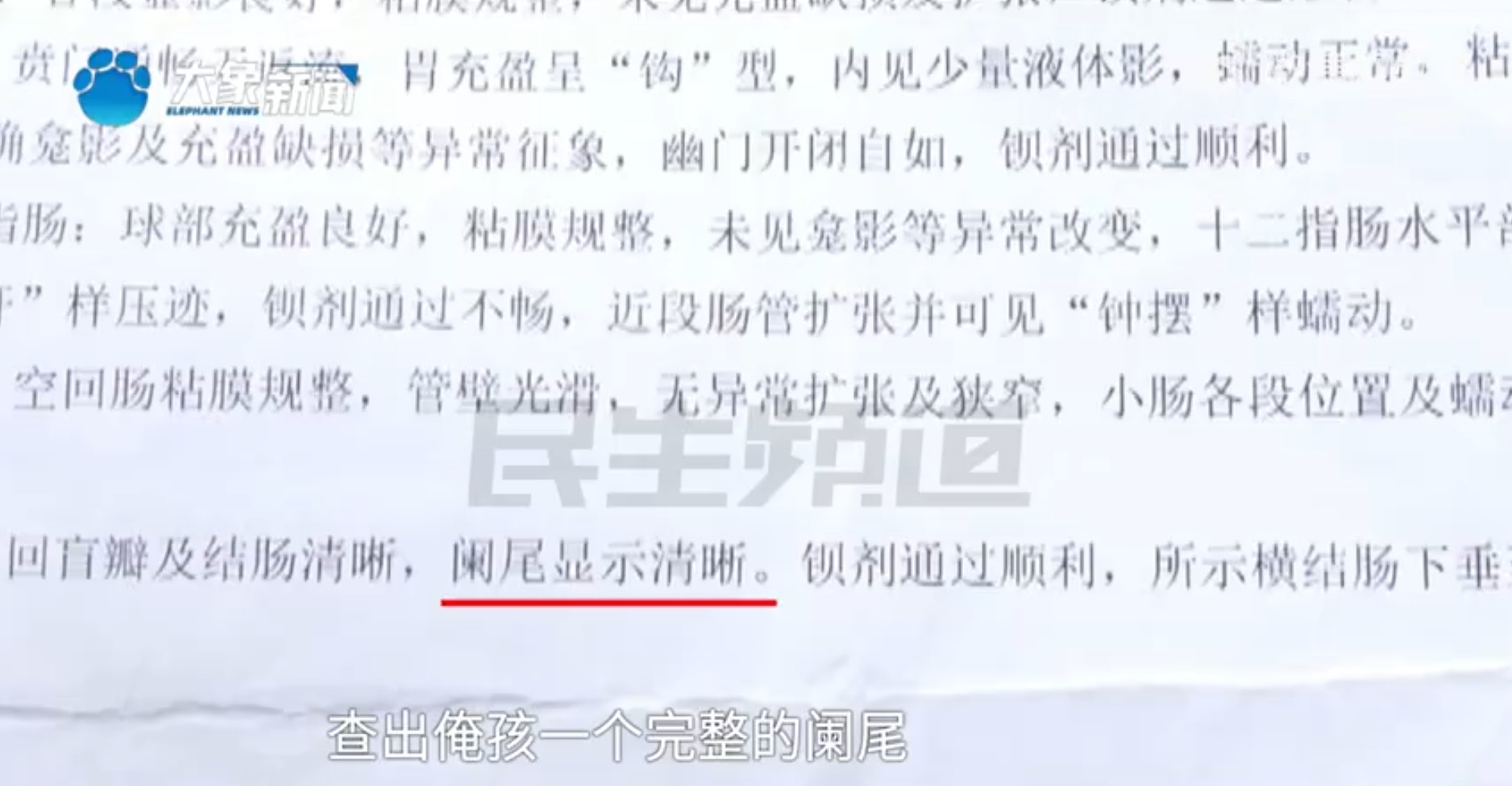 河南一名12歲男童在5年前因急性闌尾炎（俗稱盲腸炎）將闌尾切除，不料近日在進行檢查時竟發現「闌尾還在」，讓家屬頓時嚇傻：「那當時切了什麼？」對此，當地醫調委已介入調查。（微博＠小莉幫忙 ）