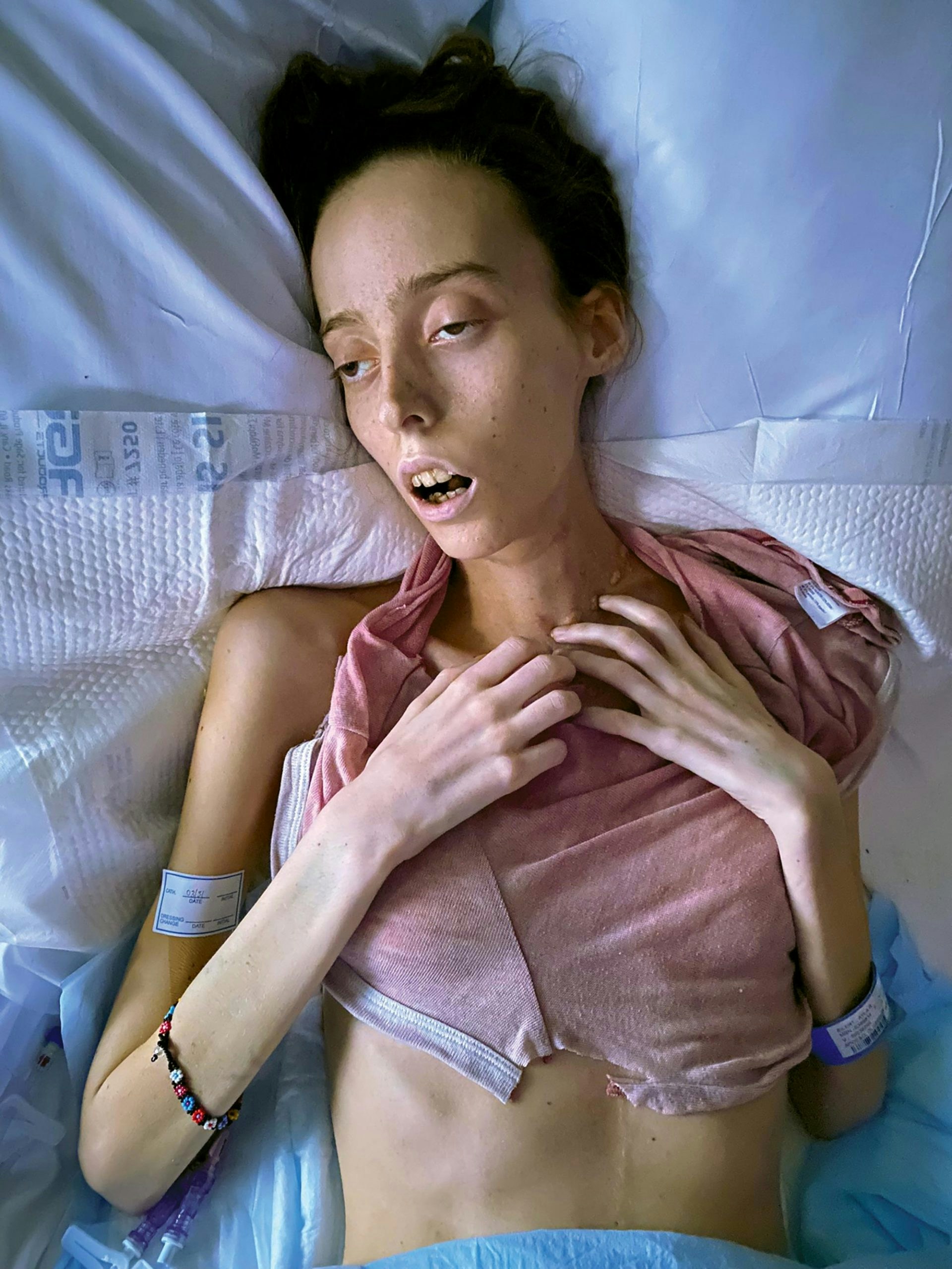 美国纽约一名年仅24岁的舞者艾拉（Ayla Eilert），自2021年5月开始感到喉咙痛，且舌头上出现溃疡，4个月后确诊罹患三大皮肤癌之一「鳞状细胞癌」。尽管她立即接受了部分舌头切除、放射及化学治疗，不过癌细胞已经转移到她身体的13个部位，7个月后仍不敌病魔病逝。（globalheroes.com）