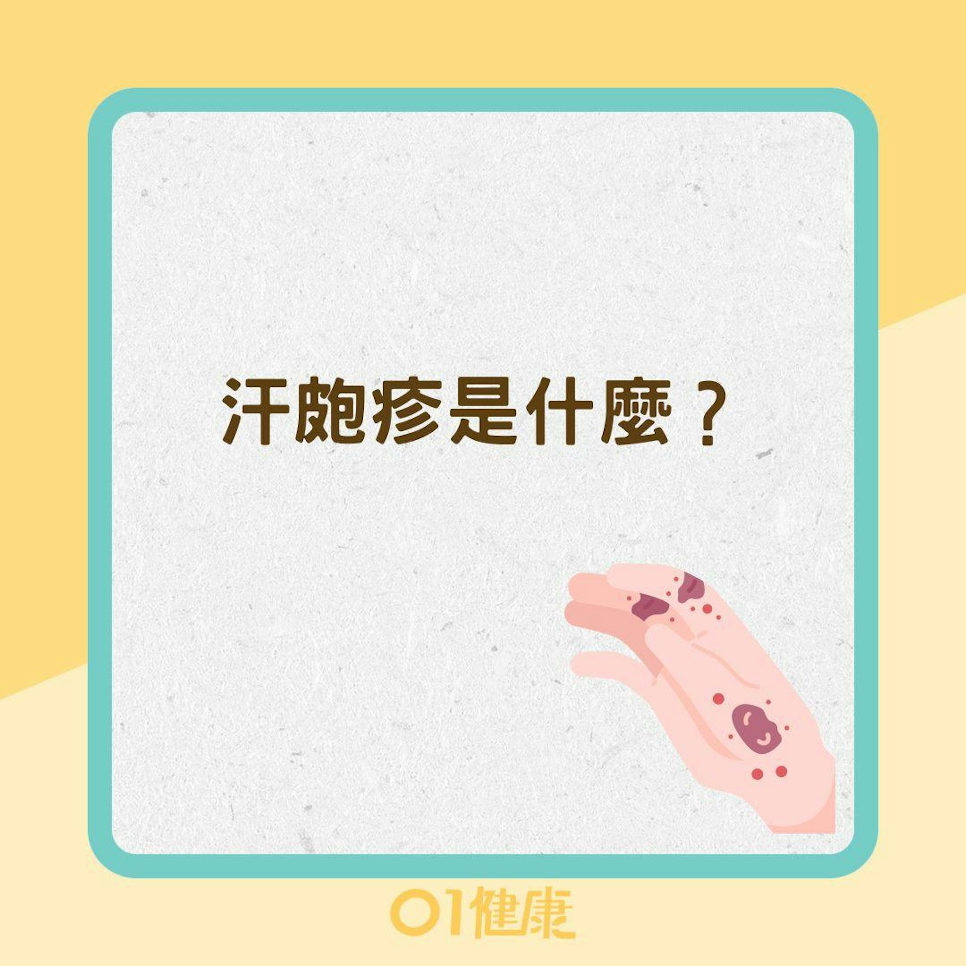 汗皰疹是什麼?(01製圖) 汗皰疹是什麼?(01製圖)