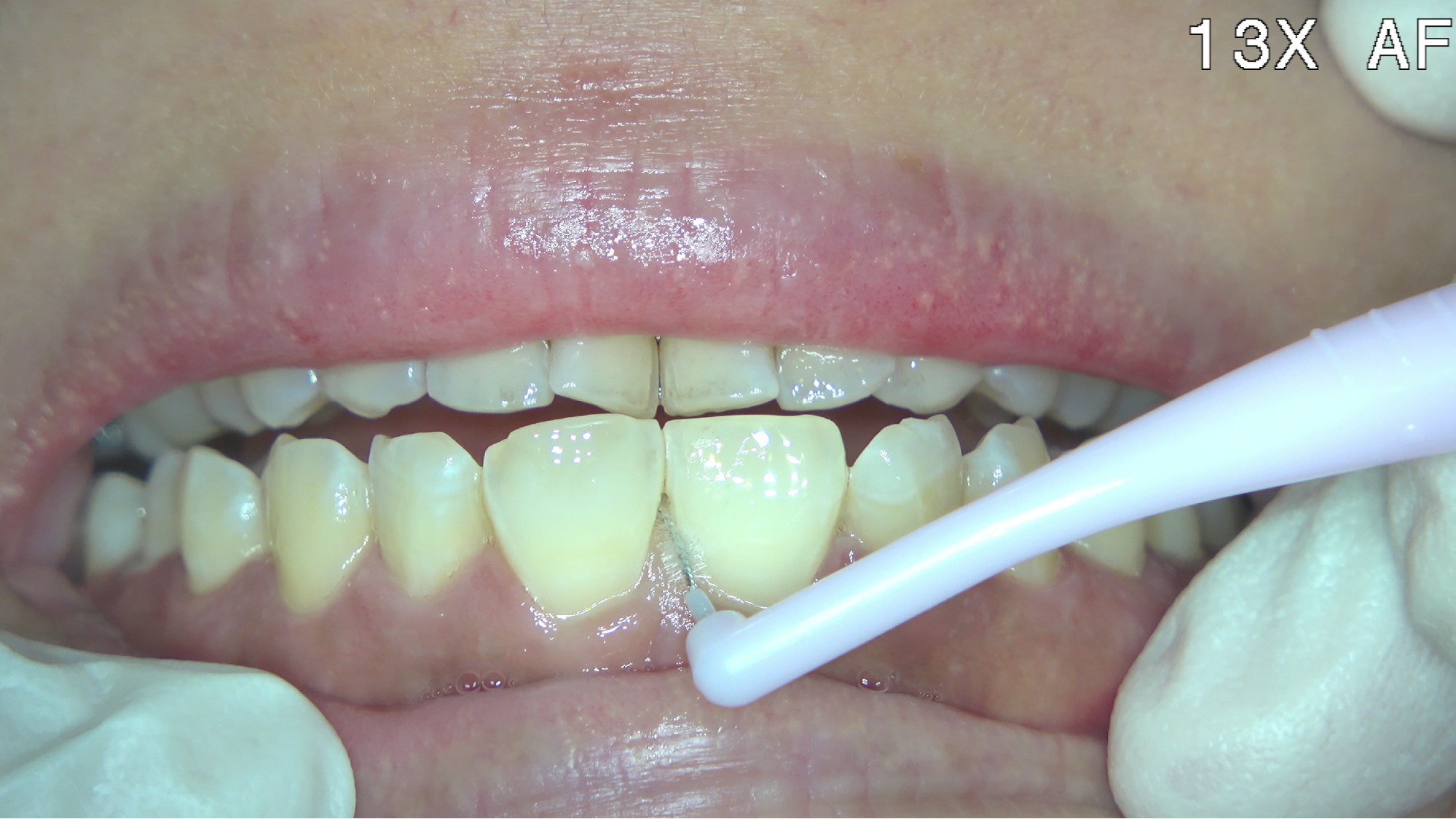 牙縫清潔可以使用牙縫刷或者牙線 
要清潔組成牙縫的左邊牙面以及右邊牙面
 也要顧及牙肉邊緣清潔